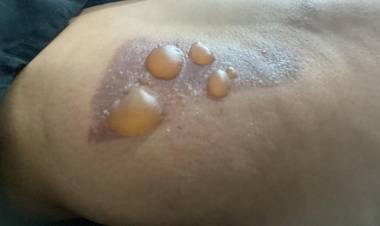Prof.ª da REME sofre queimadura de 2º grau após procedimentos de Cliolipolise em Clinica de Três Lagoas