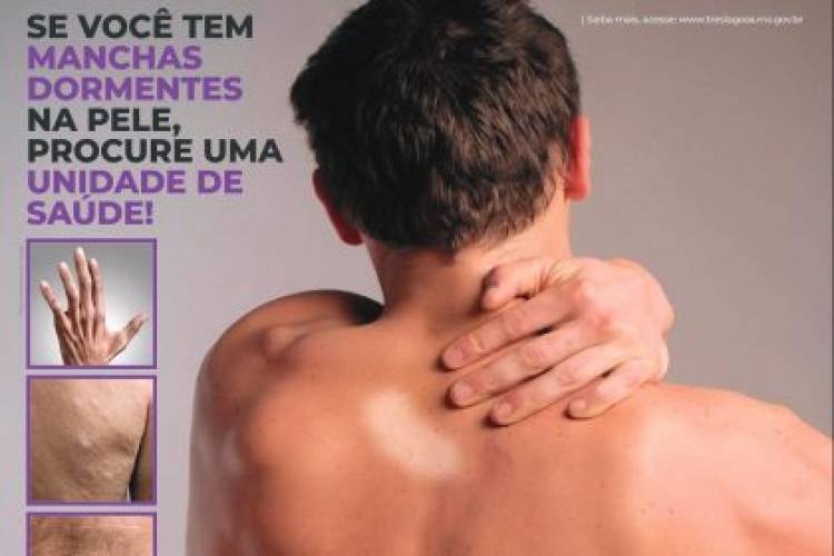 JANEIRO ROXO – Saúde de Três Lagoas orienta população sobre importância do diagnóstico e prevenção da Hanseníase