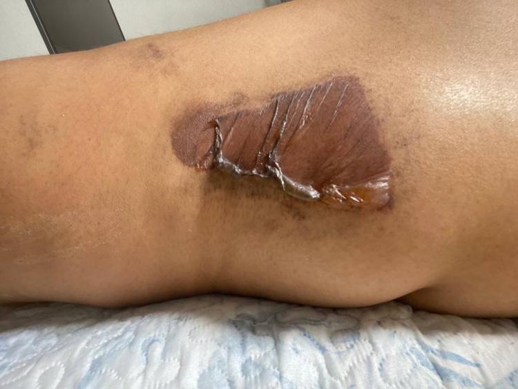 Prof.ª da REME sofre queimadura de 2º grau após procedimentos de Cliolipolise em Clinica de Três Lagoas